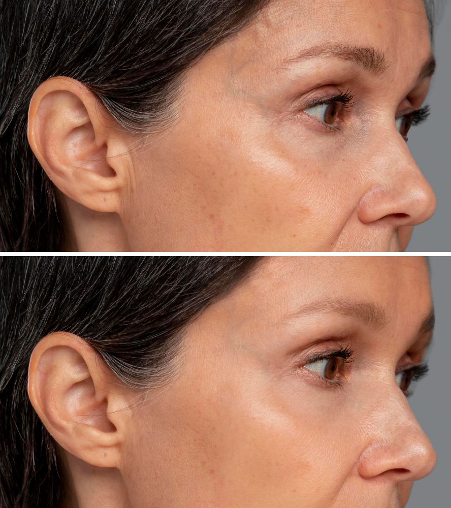 microneedling efectos