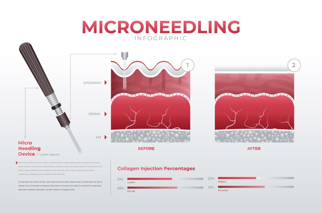 microneedling inducción de colágeno