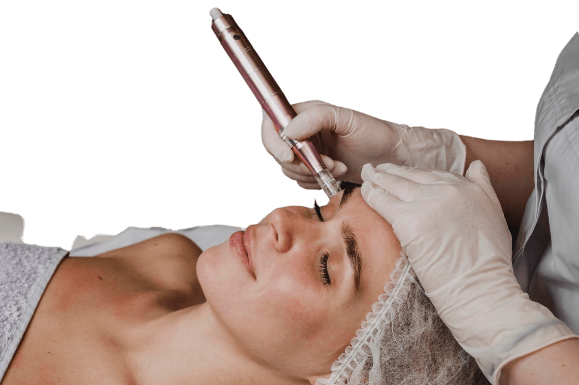 microneedling para renovar tu piel