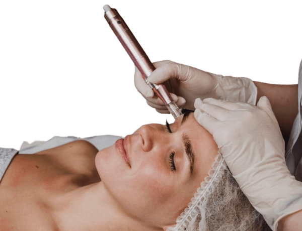 microneedling para renovar tu piel